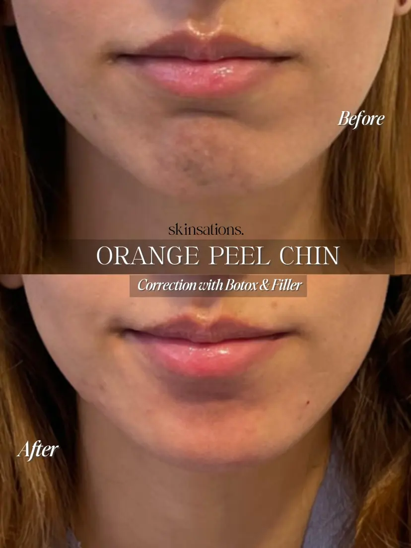 Orange-Peel Chin Smoothing & Profile Harmony — Before and After at Skinsations Lahore