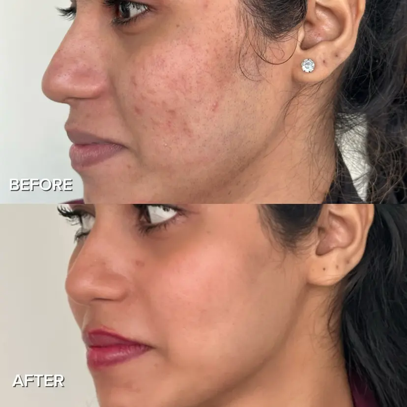 Verified 2026 Patient: 3 sessions of PRP + Microneedling + 1 session CO2 Fractional Laser.
